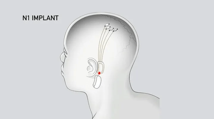 Иллюстрация интерфейса компьютер-мозг Neuralink